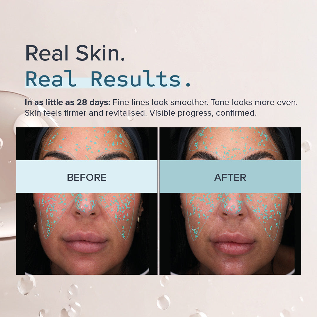 Prieš ir po IntelliRET 0.3+